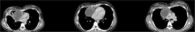 Case Report: Diffuse Large B-Cell Lymphoma in the Wall of a Thymic Cyst